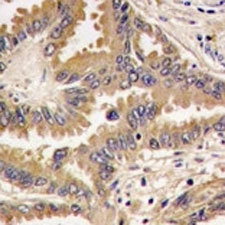 IHC analysis of FFPE human lung carcinoma tissue stained with Bad antibody
