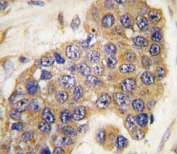 IHC analysis of FFPE human breast carcinoma tissue stained with Puma antibody