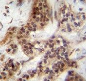 FOXA2 antibody immunohistochemistry analysis in formalin fixed and paraffin embedded human bladder carcinoma.