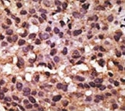 IHC analysis of FFPE human breast carcinoma tissue stained with the BNIP3 antibody