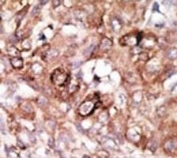 IHC analysis of FFPE human hepatocarcinoma tissue stained with the Bad antibody