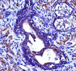 ACTG2 antibody immunohistochemistry analysis in formalin fixed and paraffin embedded human prostate cancinoma.~