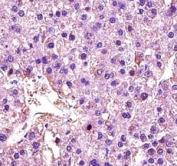 LDHA antibody immunohistochemistry analysis in formalin fixed and paraffin embedded human hepatocarcinoma