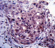 Estrogen Receptor antibody immunohistochemistry analysis in formalin fixed and paraffin embedded human breast carcinoma.