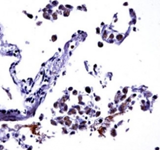 IL-13 antibody immunohistochemistry analysis in formalin fixed and paraffin embedded human lung tissue.