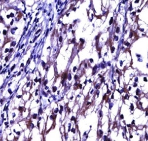 OPG antibody immunohistochemistry analysis in formalin fixed and paraffin embedded human kidney carcinoma.