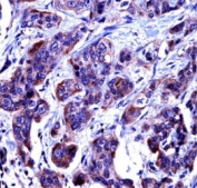 Caspase-6 antibody immunohistochemistry analysis in formalin fixed and paraffin embedded human bladder carcinoma.