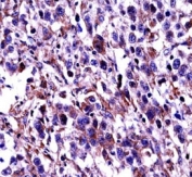 Oct-2 antibody immunohistochemistry analysis in formalin fixed and paraffin embedded human testis carcinoma.