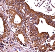 RIPK1 antibody immunohistochemistry analysis in formalin fixed and paraffin embedded human prostate carcinoma.