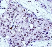 MYB antibody immunohistochemistry analysis in formalin fixed and paraffin embedded human breast carcinoma.