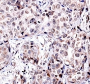 SIRT6 antibody immunohistochemistry analysis in formalin fixed and paraffin embedded human breast carcinoma.