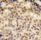 IHC analysis of FFPE human prostate carcinoma tissue stained with SOX9 antibody