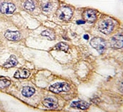 IHC analysis of FFPE human lung carcinoma tissue stained with CD8A antibody