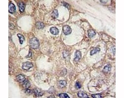 IHC analysis of FFPE human hepatocarcinoma tissue stained with AFP antibody~