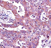 JAK2 antibody immunohistochemistry analysis in formalin fixed and paraffin embedded human lung adenocarcinoma.