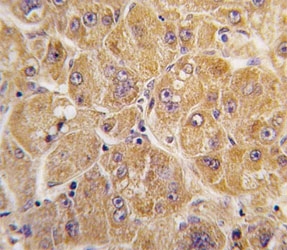 IHC analysis of FFPE human hepatocarcinoma tissue stained with ALDH1A1 antibody