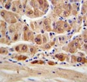 ALDH1A1 antibody IHC analysis in formalin fixed and paraffin embedded human hepatocarcinoma.