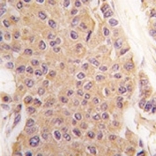IHC analysis of FFPE human breast carcinoma tissue stained with TGF Beta 2 antibody