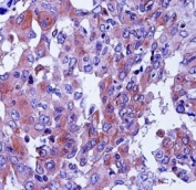 CD55 antibody immunohistochemistry analysis in formalin fixed and paraffin embedded human lung adenocarcinoma.