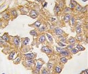 IHC analysis of FFPE human lung carcinoma tissue stained with ACTC1 antibody