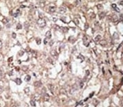 IHC analysis of FFPE human hepatocarcinoma tissue stained with the TLR1 antibody