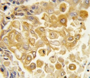 IHC analysis of FFPE human lung carcinoma tissue stained with TLR2 antibody