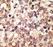 IHC analysis of FFPE human hepatocarcinoma tissue stained with the anti-TLR2 antibody