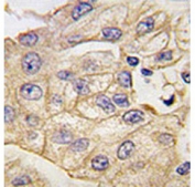 IHC analysis of FFPE human lung carcinoma tissue stained with anti-TLR2 antibody