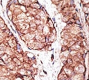 IHC analysis of FFPE human breast carcinoma tissue stained with the TLR5 antibody