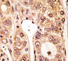 IHC analysis of FFPE human hepatocarcinoma tissue stained with the TLR5 antibody~