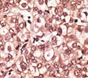 IHC analysis of FFPE human hepatocarcinoma tissue stained with the TLR6 antibody