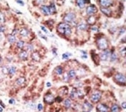 IHC analysis of FFPE human hepatocarcinoma tissue stained with the TLR6 antibody