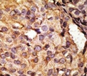 IHC analysis of FFPE human breast carcinoma tissue stained with the TLR6 antibody