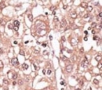 IHC analysis of FFPE human hepatocarcinoma tissue stained with the anti-TLR7 antibody