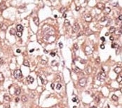 IHC analysis of FFPE human hepatocarcinoma tissue stained with the anti-TLR7 antibody