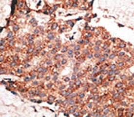 IHC analysis of FFPE human breast carcinoma tissue stained with the BMP1 antibody~