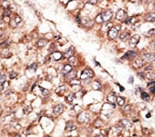 IHC analysis of FFPE human hepatocarcinoma tissue stained with the BMP3 antibody