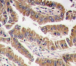 IHC analysis of FFPE human lung carcinoma tissue stained with BMP4 antibody
