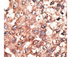 IHC analysis of FFPE human hepatocarcinoma tissue stained with the BMP5 antibody~