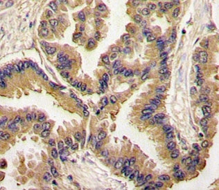 IHC analysis of FFPE human lung carcinoma tissue stained with BMP6 antibody~