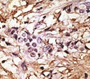 IHC analysis of FFPE human breast carcinoma tissue stained with the LC3B antibody.