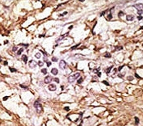 IHC analysis of FFPE human breast carcinoma tissue stained with the LC3B antibody