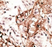 IHC analysis of FFPE human breast carcinoma tissue stained with the LC3C antibody