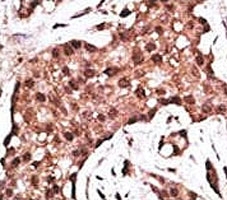 IHC analysis of FFPE human breast carcinoma tissue stained with the ATG5 antibody