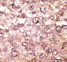 IHC analysis of FFPE human hepatocarcinoma tissue stained with the anti-ATG5 antibody