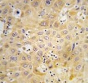 IHC analysis of FFPE human hepatocarcinoma tissue stained with ATG7 antibody