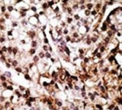 IHC analysis of FFPE human breast carcinoma tissue stained with the ATG7 antibody