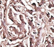 IHC analysis of FFPE human breast carcinoma tissue stained with the APG7 antibody