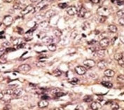 IHC analysis of FFPE human hepatocarcinoma tissue stained with the ATG7 antibody