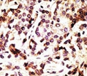 IHC analysis of FFPE human breast carcinoma tissue stained with the Beclin 1 antibody
